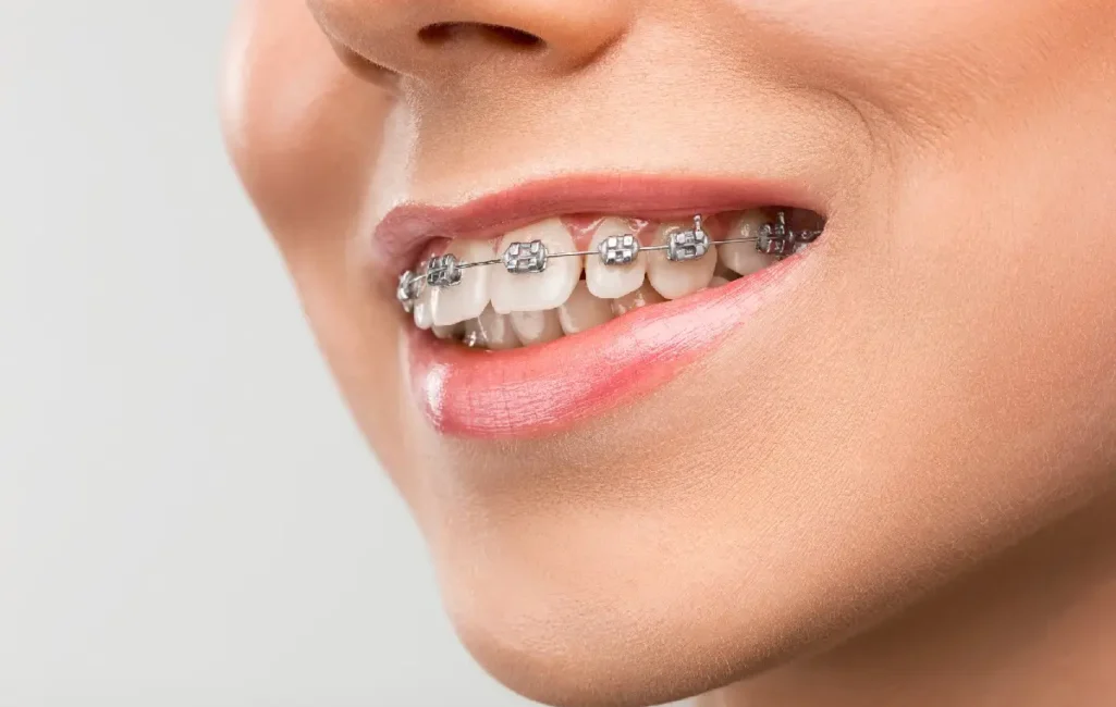 orthodontic-braces
