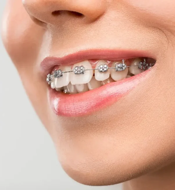orthodontic-braces