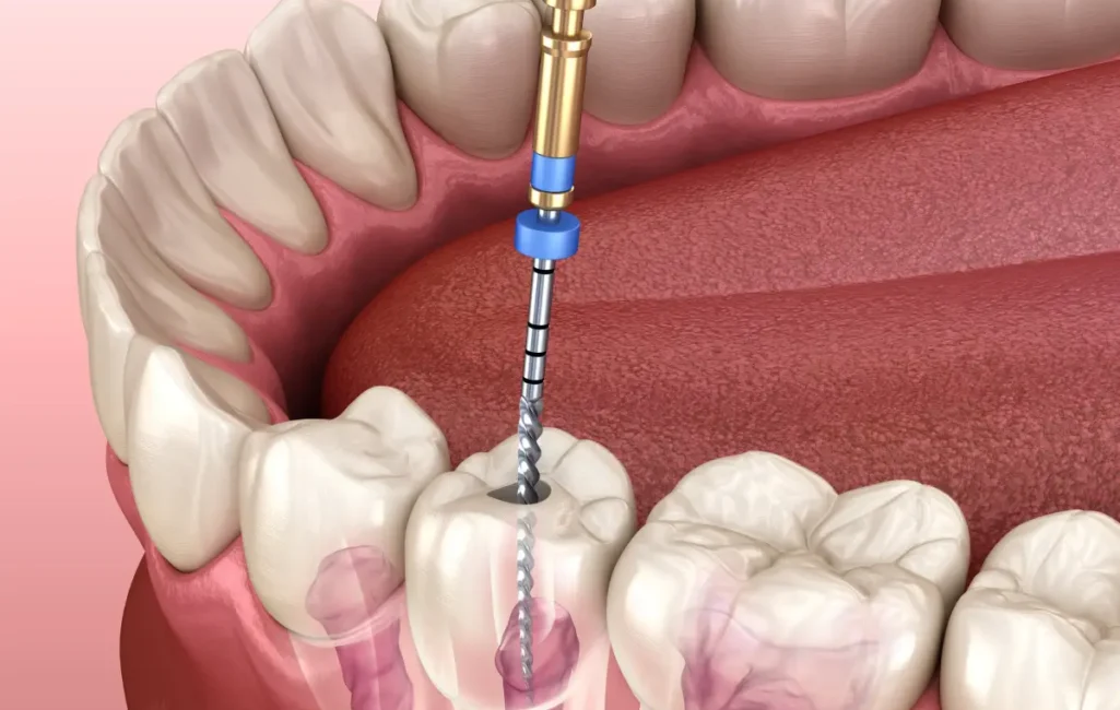 root-canal-treatment