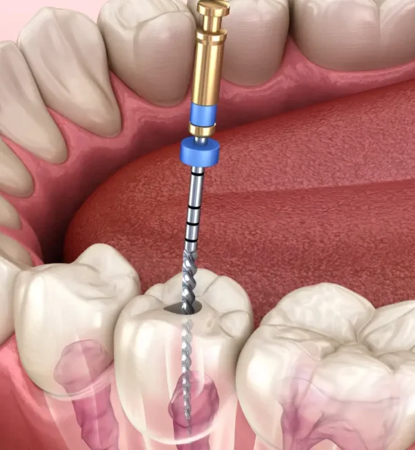 root-canal-treatment